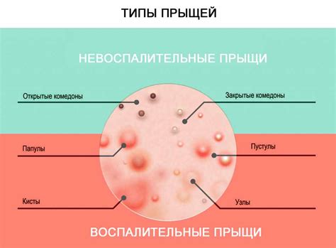 Как лечить прыщи с желтой жидкостью