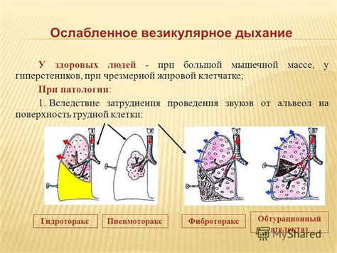 Как определить везикулярное дыхание?