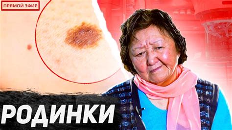 Как определить опасность родинок на грудинке