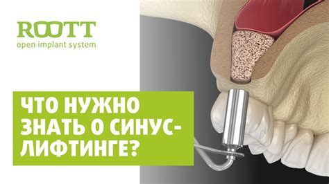 Как повысить эффективность синус лифтинга?