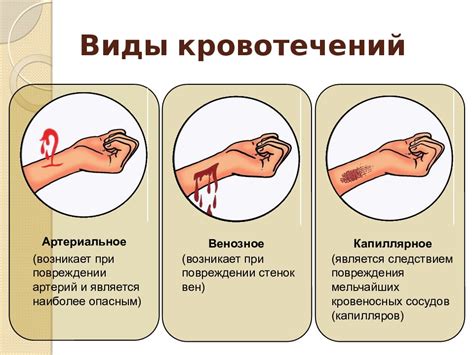 Как правильно определить вид кровотечения