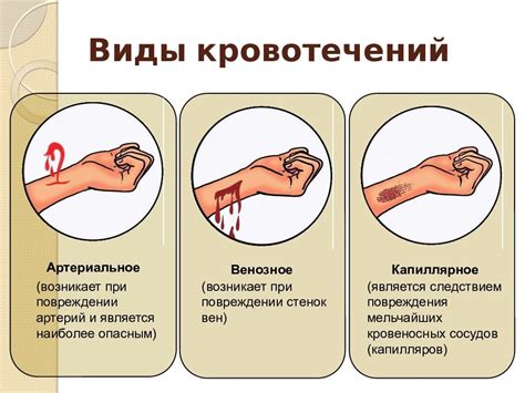 Как правильно остановить кровотечение