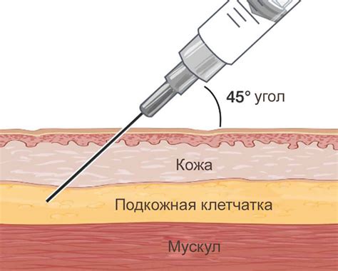 Как провести инъекцию баралгина