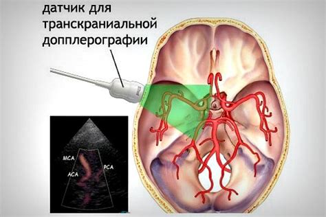 Как проводится ангиограмма сосудов головного мозга?