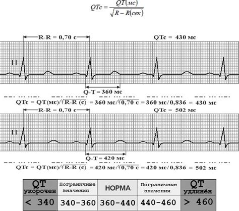Как проводится измерение и интерпретация корригированного интервала QT