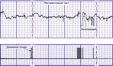 Как проводится нестрессовый тест реактивный на КТГ