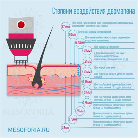 Как проходит процедура фракционной мезотерапии?