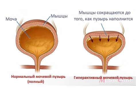 Как снизить давление на мочевой пузырь?