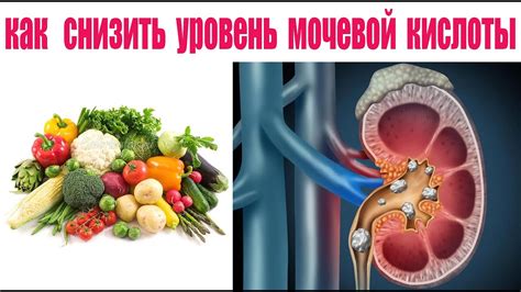 Как сократить уровень мочевой кислоты