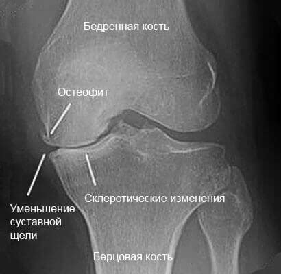 Как увеличить количество хряща в коленном суставе