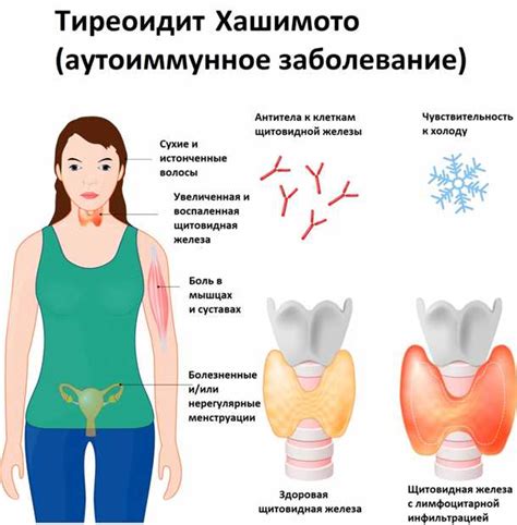 Как укрепить щитовидную железу: эффективные советы и методы