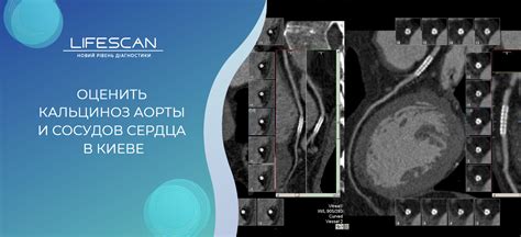 Кальциноз аорты и коронарных сосудов: определение и симптомы