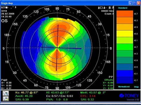 Кератотопография: измерение формы роговицы для определения астигматизма
