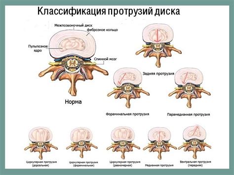 Комплексное лечение циркулярного пролабирования межпозвонковых дисков