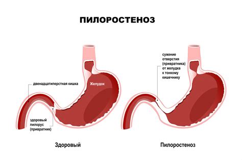 Коричневая рвота у человека