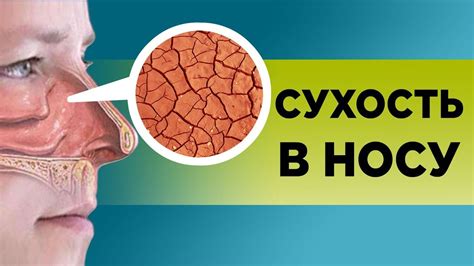 Корки сухости в носу: причины и способы лечения