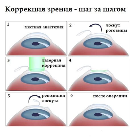 Коррекция зрения: методы и результаты