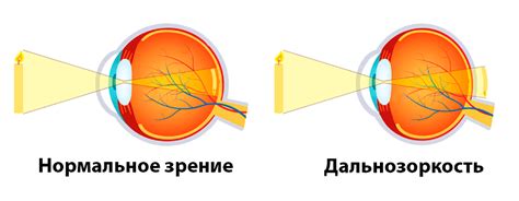 Лечение гиперметропии 2 степени обоих глаз