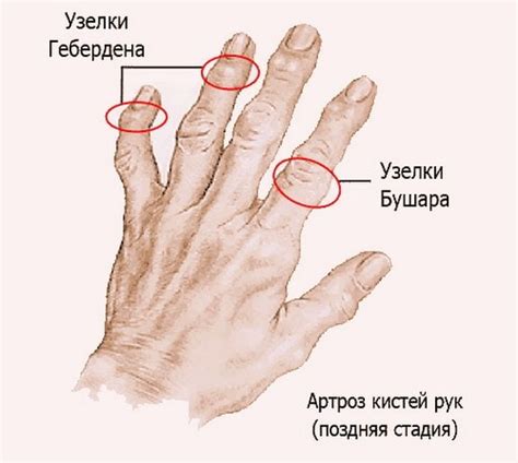 Лечение доа мелких суставов кистей рук