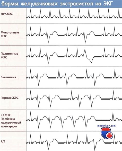 Лечение желудочковой экстрасистолии бигеминия