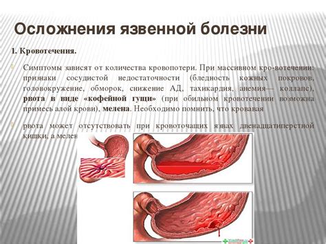 Лечение и последствия внутрибрюшного кровотечения