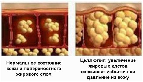 Лечение на ранней стадии застуды