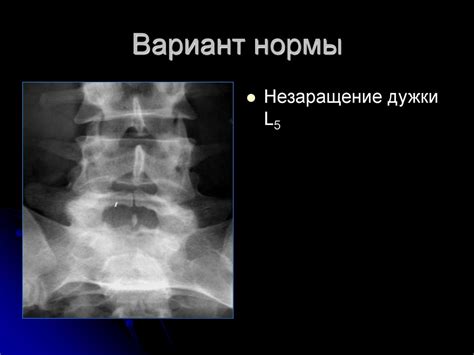 Лечение незаращения задней дуги s1 позвонка