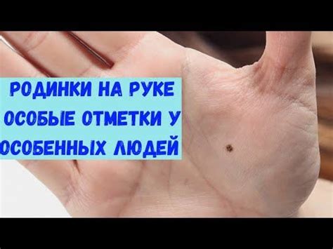 Лечение родинки на руке