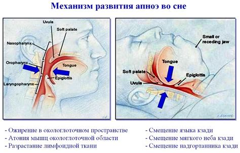 Лечение синдрома апноэ во время сна