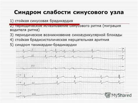 Лечение синусовой брадиаритмии