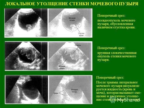 Лечение утолщения стенок мочевого пузыря