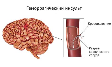 Лечение уточненных поражений сосудов мозга