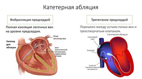 Лечение фибрилляции предсердий и трепетания предсердий