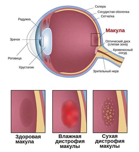 Макулодистрофия сетчатки