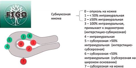 Маточные миомы и полипы