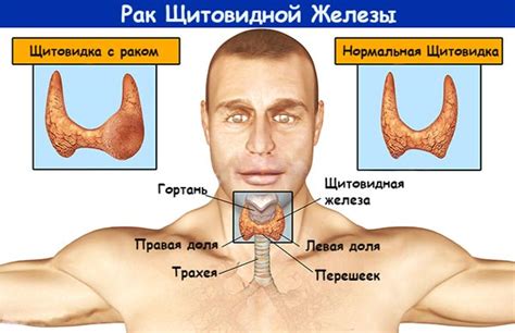 Медикаментозное лечение увеличения щитовидной железы