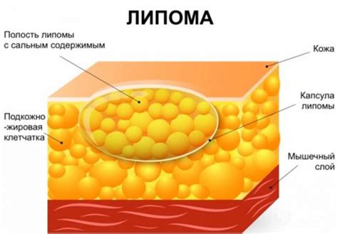 Медицинские методы удаления липомы на руке