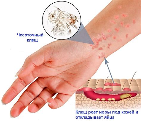 Медицинские объяснения чесотки на левой руке у молодого человека