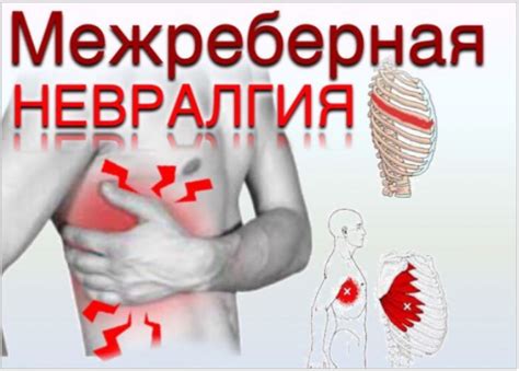 Межреберная невралгия и мышечные проблемы