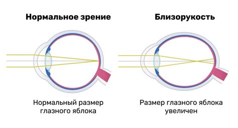 Методы восстановления зрения при миопии