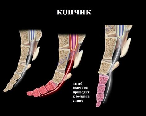 Методы диагностики повреждения или травмы копчика