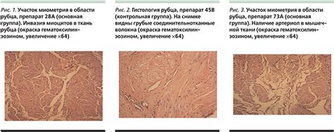 Методы лечения и восстановления разошедшегося шва на матке