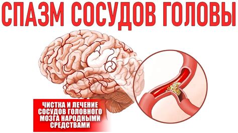 Методы лечения и профилактики спазмов сосудов головного мозга