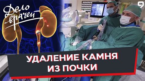 Методы лечения камня в почке размером 23 мм