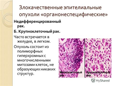 Методы лечения опухоли в правом легком