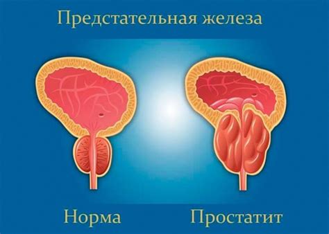 Методы лечения сросшейся крайней плоти