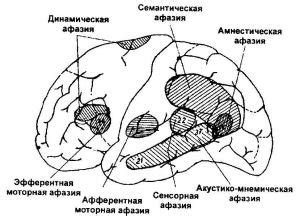 Методы обучения пациентов с афазией коммуникации и восстановления речи