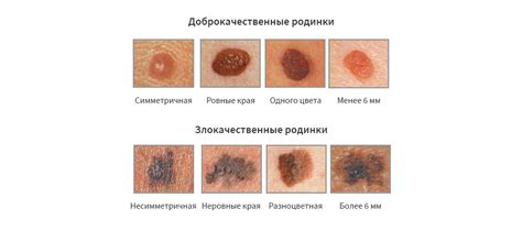 Методы определения папилломы или родинки