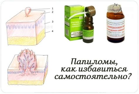 Методы удаления папиллом