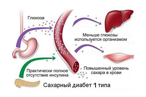 Механизм развития 1 типа сахарного диабета